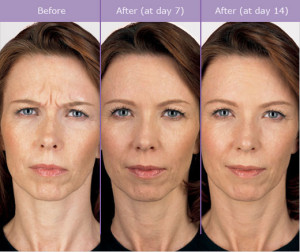 female before and after botox